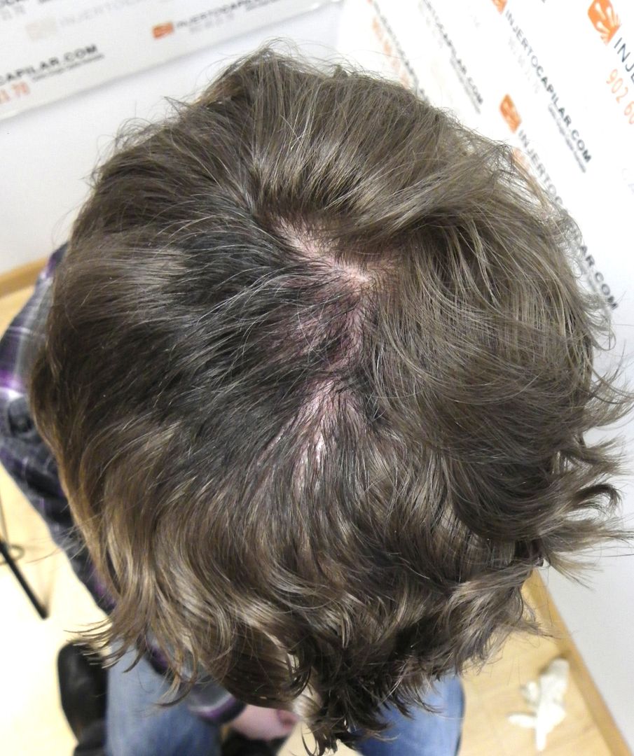Case 3. Heterocromy. Lorenzo Results Posted by Leading Hair