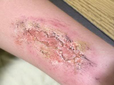 Рваная рана, своими руками =) !