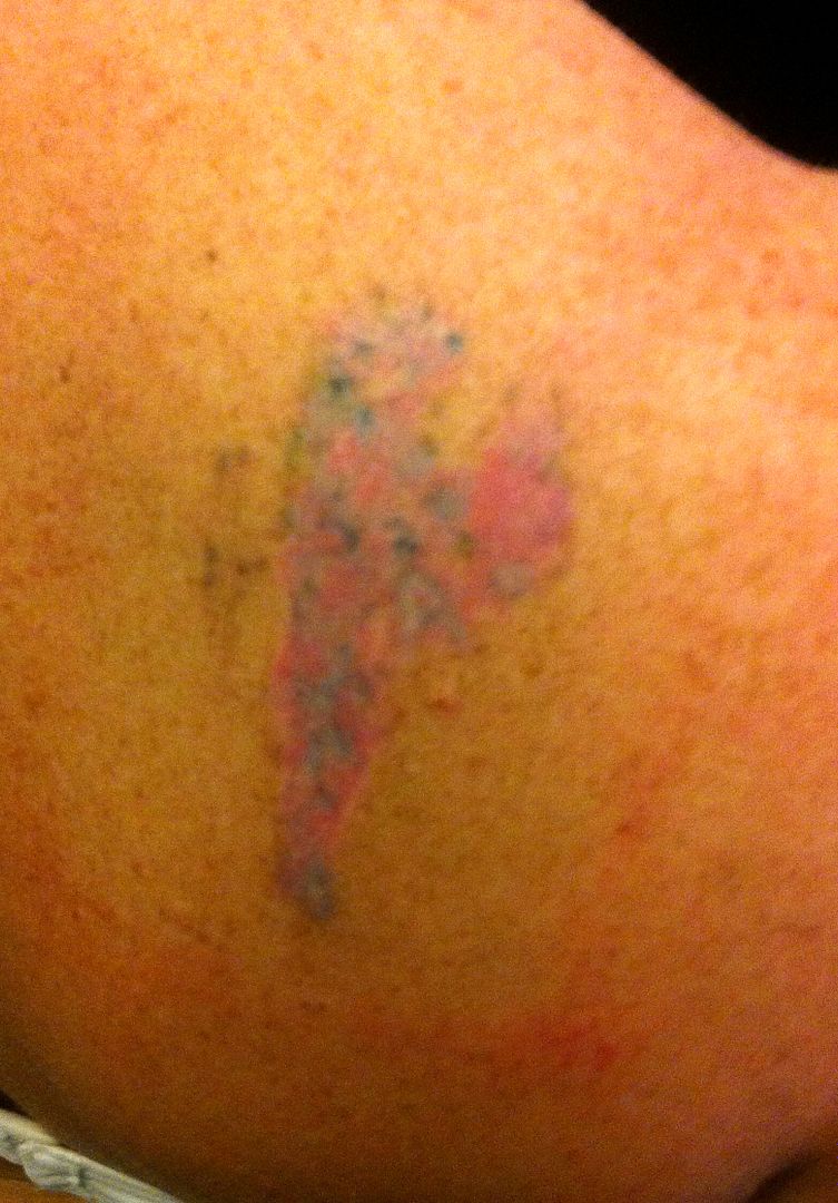 Laser Tattoo Removal...In case you are curious! | WDWMAGIC ...