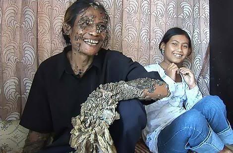 AussiE-media : Tree man who grew roots may be cured