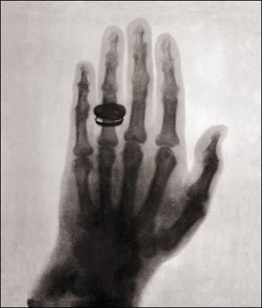 AussiE-media : First Human X-ray 1896